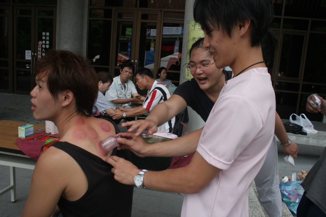 中山大學中醫社拔罐圖片