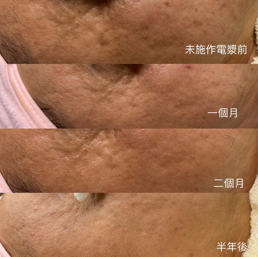 Thanks to its high penetration and reactivity, plasma can also be used for skin whitening, spot reduction, enhanced skin radiance, deep exfoliation, and stubborn oil removal.Image